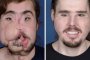 Мъж с трансплантирано лице: Отново мога да се усмихна