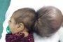 Лекари оперираха двуглаво дете в Афганистан