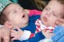 Двучасова операция раздели сиамски близнаци в Пирогов