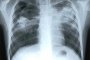 28 болници преглеждат безплатно за туберкулоза 