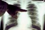 Следващата вълна след Covid ще бъде от туберкулоза: Пулмолог