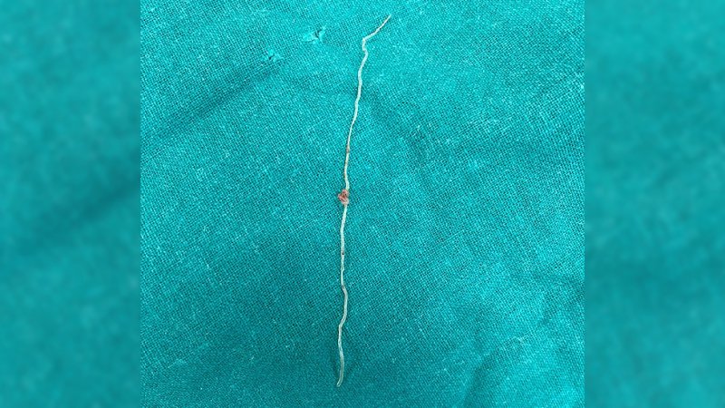 Лекарите са отстранили 12-сантиметров червей от бузата на жена, ухапана